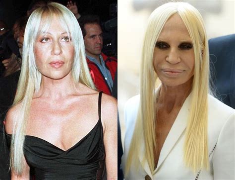 Donatella Versace Before and After Plastic Surgery .